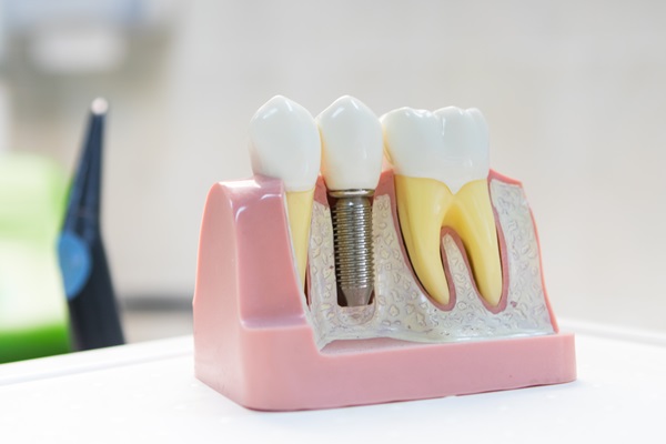 Oral Surgery For Dental Implant